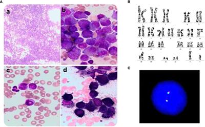 Case report: Identification of a novel HNRNPC::RARG fusion in acute promyelocytic leukemia lacking RARA rearrangement